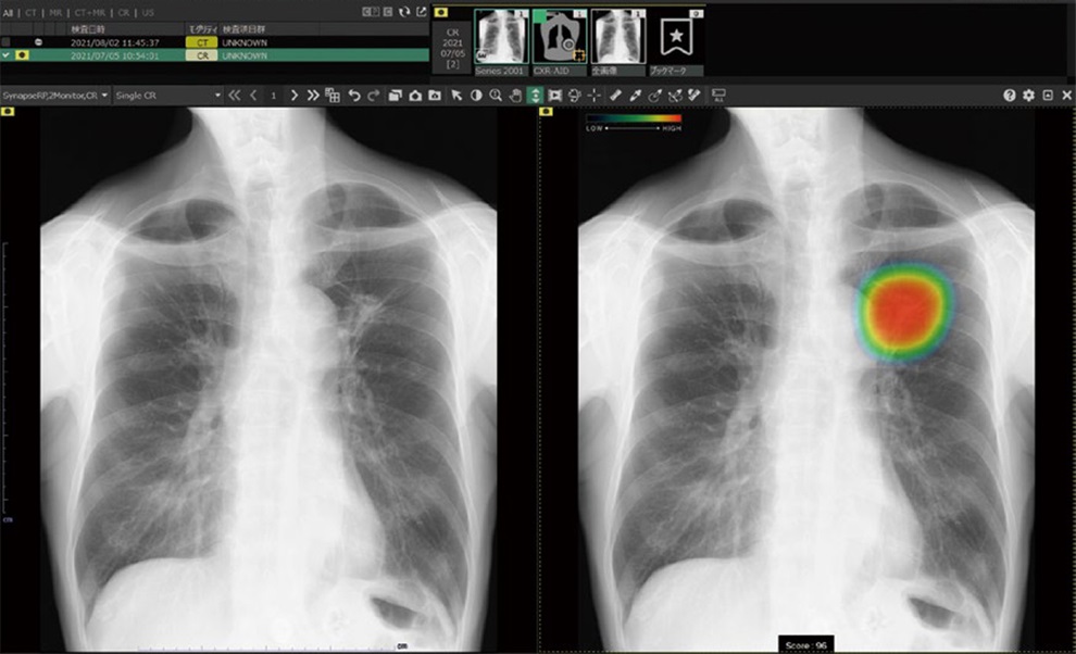 胸部X線画像病変検出ソフトウェア「CXR-AID」